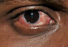 Dad ku indho-beelay kaadi ay ku fool dhaqdeen simiskaga daweeyan xanuunka indhaha ku dhaca ee bakoorada,